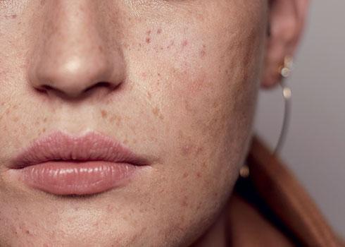 Acne adulte a casablanca causes traitements et conseils